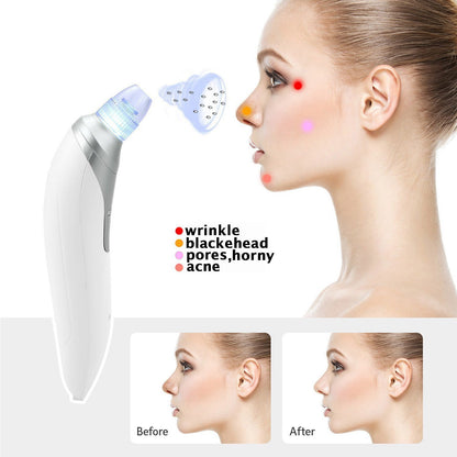 Blackhead Remover